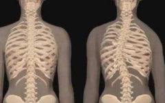 [江苏镇江]儿童身高体重测量仪厂家：脊柱侧弯对身体的重大影响7.27